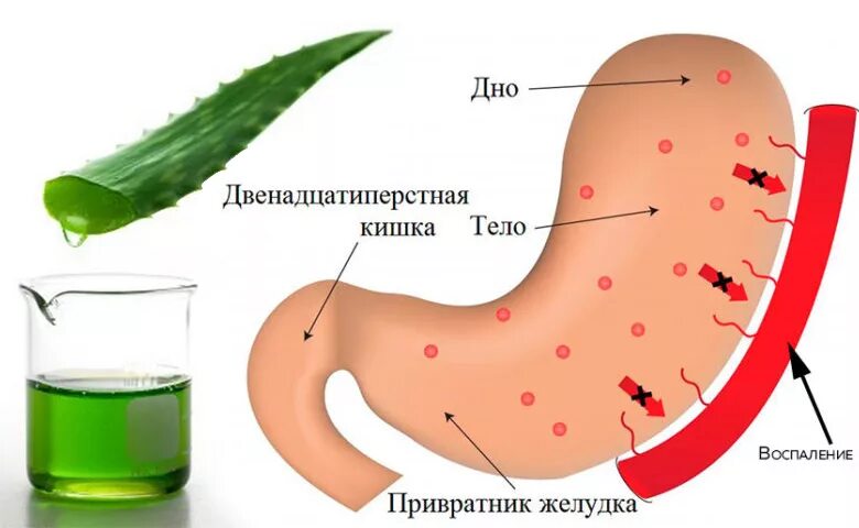 Алоэ при язве желудка