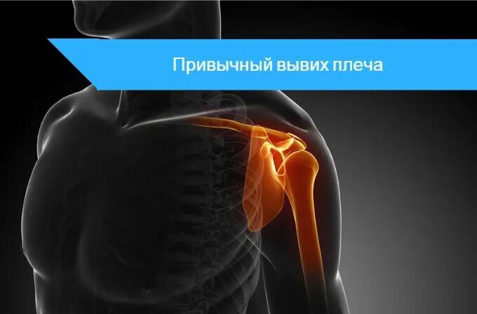 Привычный вывих плечевого сустава. Привычный вывих плеча симптомы. привычный подвывих плечевого сустава. привычный подвывих плеча.