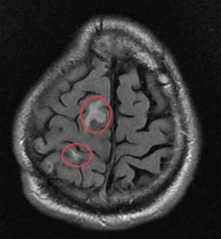 Очаг глиоза в теменной доле. Кортикальный очаг глиоза. Кистозно-глиозные изменения мрт. Глиоз головного мозга кт. Мрт глиозные очаги.