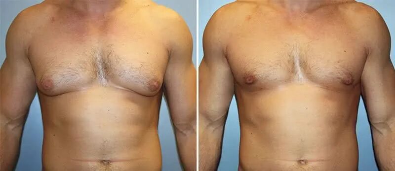 Мужчины после операции. Тутанхамон гинекомастия. Гинекомастия у мужчин до и после операции. Пластика мужской груди.