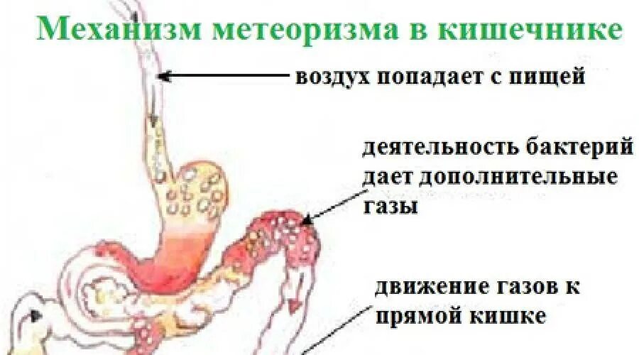 Постоянный метеоризм. Метеоризм и вздутие кишечника. Механизм газообразования в кишечнике.