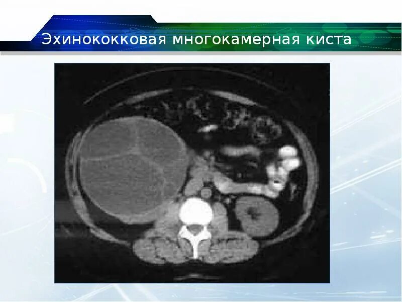 Киста печени мрт. Эхинококковая киста селезенки кт. Эхинококковая киста печени кт. Эхинококковая киста на кт. Эхинококковая киста почки УЗИ.