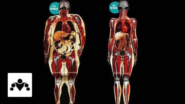 Кость тяжелая правда. Скелет толстого человека рентген. Кость тяжелая правда. Человек с широкими костями. Люди с широкой костью.