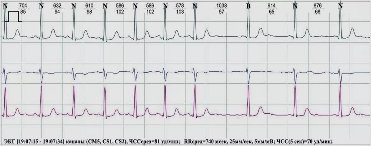 Са блокада 2 тип. Синоатриальная блокада Мобитц 1 ЭКГ. Са блокада 1 степени на ЭКГ. Са блокада на Холтер ЭКГ. Са блокада 3 степени на ЭКГ.