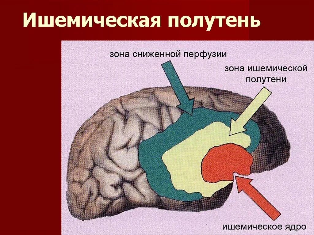 Зона ишемии. Зона ишемической полутени. Ишемическая полутень.