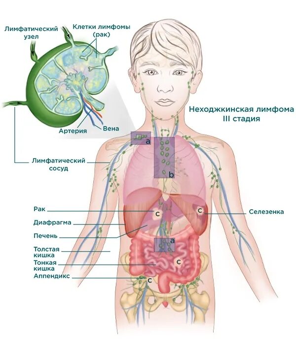 Лимфома лимфатические узлы. Неходжкинские лимфомы. Не ходжскинская лимфома. Неходжкинские лимфомы у детей. Лимфобластная неходжкинская лимфома.