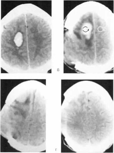 Субдуральная гематома на кт. Параорбитальная гематома на кт. Рентген черепа субдуральная гематома. Ретроамниальная гематома. Гематома в стадии организации