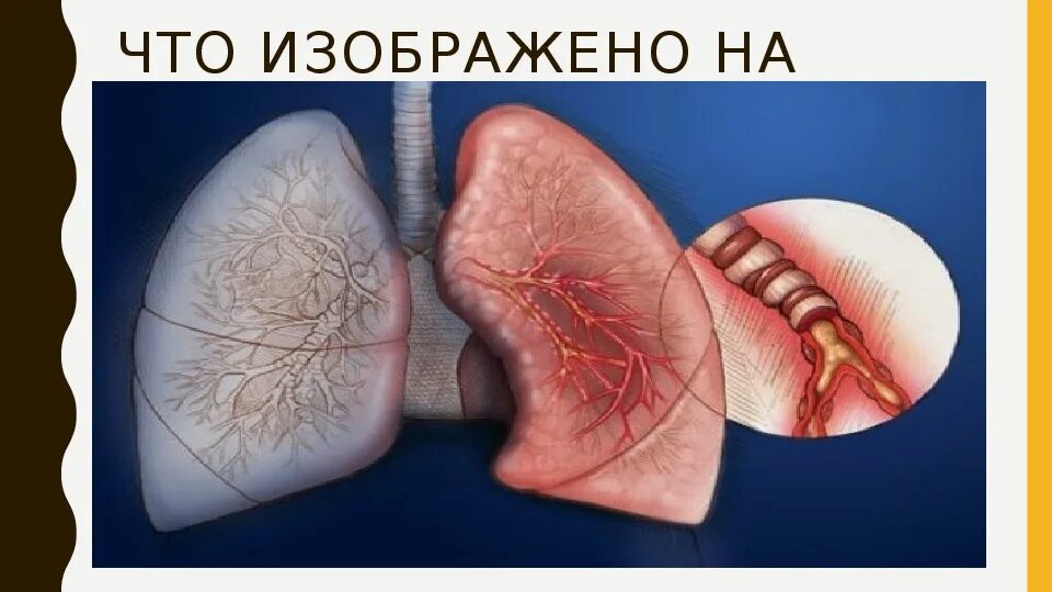 Острый катаральный бронхит. Острый и хронический бронхит. Гнойный трахеобронхит.