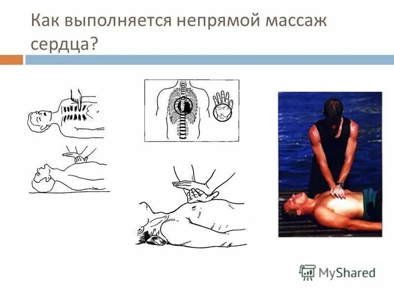 Как выполняется непрямой массаж сердца. Непрямой массаж сердца алгоритм действий. Как выполняется непрямой массаж сердца. Массаж сердца алгоритм действий. Как выполняется непрямой массаж сердца.