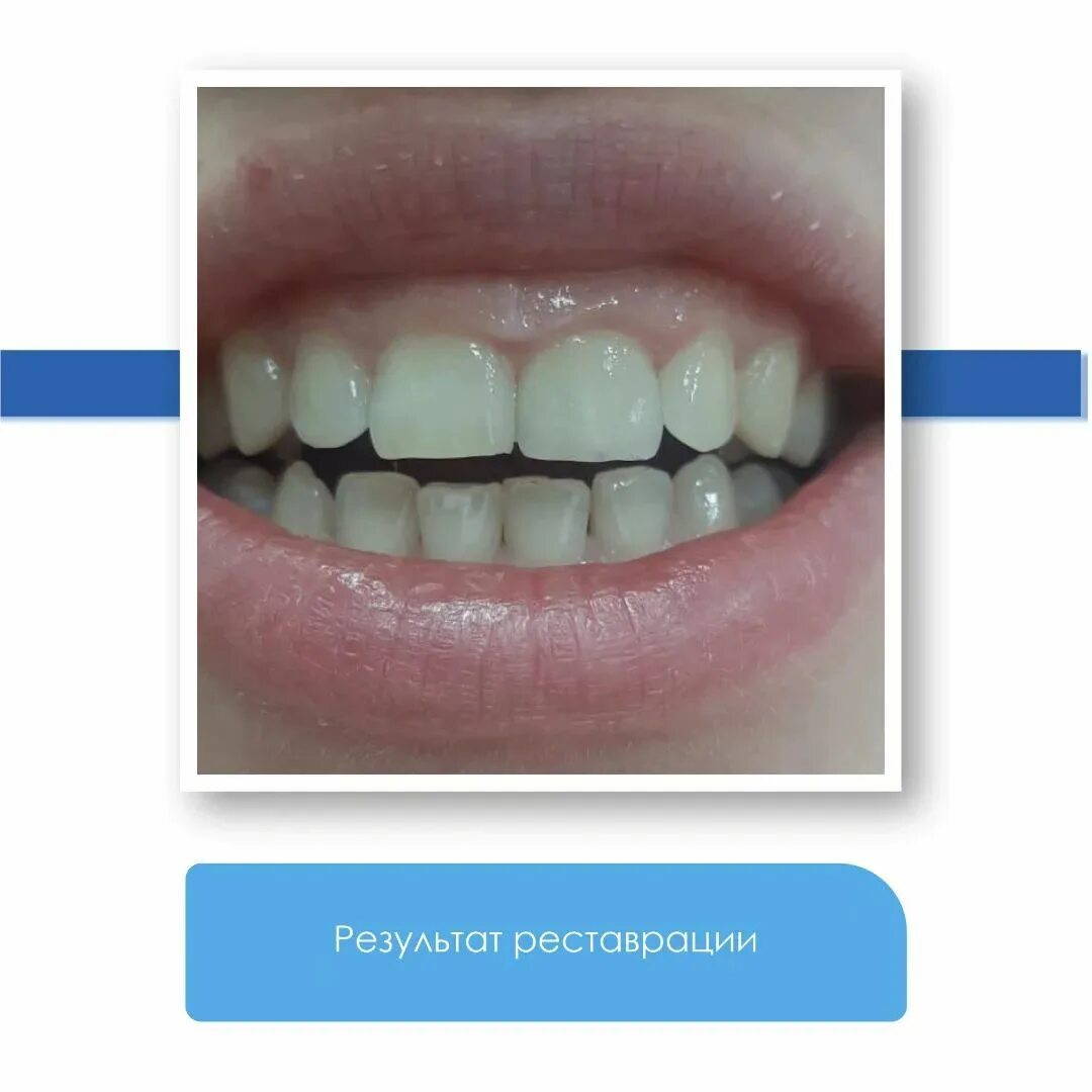 Реставрация передних зубов. Реставрация фронтальных зубов.