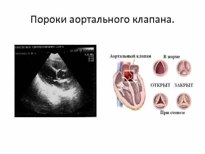 Кальциноз митрального клапана. Кальциноз аортального клапана. Кальциноз створок аортального клапана. Кальциноз аортального клапана 3 степени. Кальциноз аортального клапана степени.