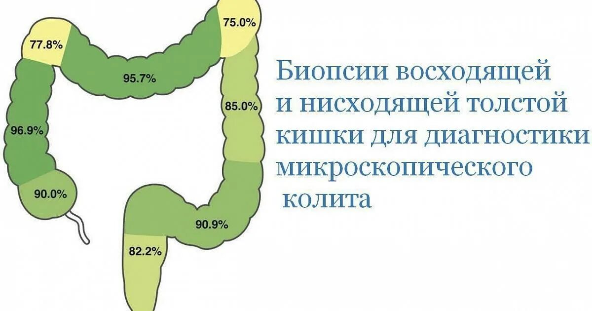 Биоптат кишки. Тубулярная и зубчатая аденома толстой кишки. Зубчатая аденома толстой кишки эндоскопическая картина. Зубчатая аденома в восходящей ободочной кишки. Зубчатая аденома прямой кишки.