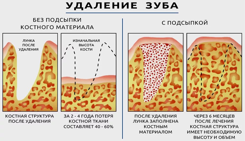 Стадии заживления после. Пластика кости при имплантации костной ткани. Аугментация костной ткани. Костная ткань в стоматологии. Наращивание костной ткани зуба.