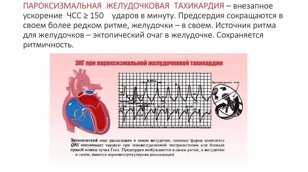 Желудочковая тахикардия на экг