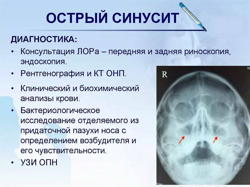 Что такое фронтит. Острый фронтит острый синусит. острый верхнечелюстной синусит. хронический синусит риноскопия. острый гнойный верхнечелюстной синусит.