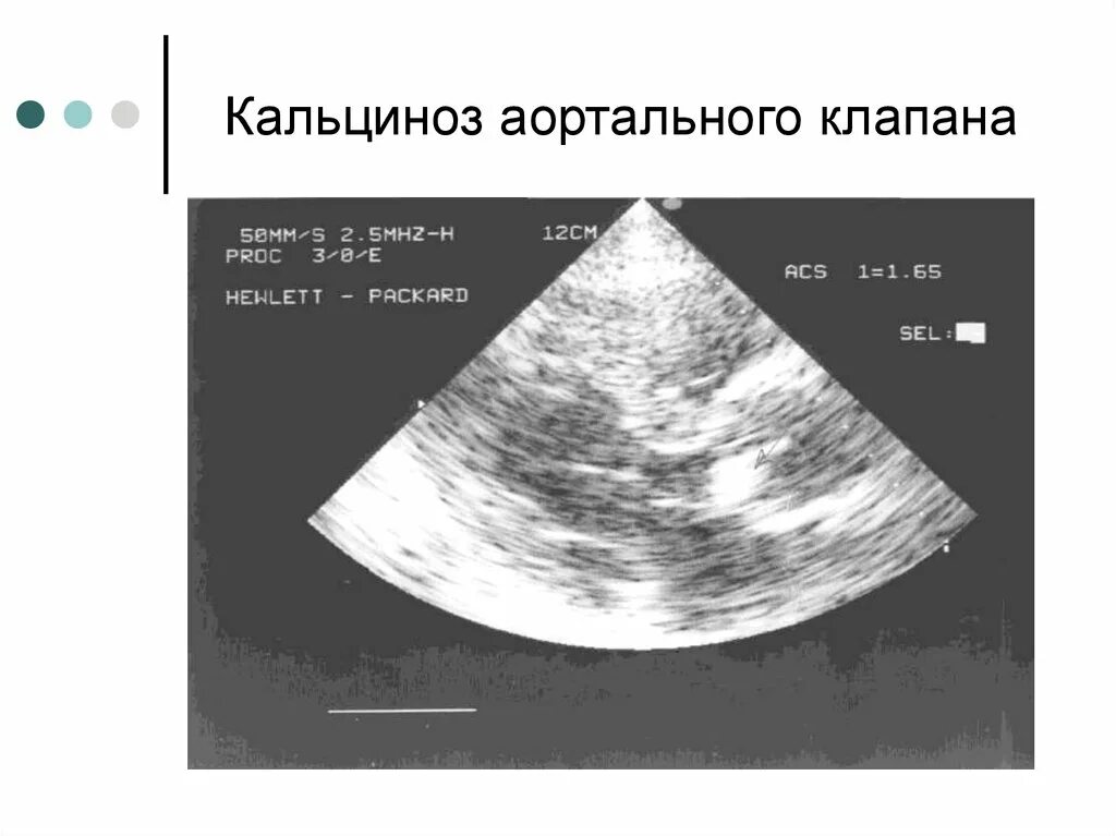 Кальциноз аортального клапана 1. Кальциноз створок клапанов сердца. Симптомы кальциноза митрального клапана. Кальцинат створки аортального клапана.