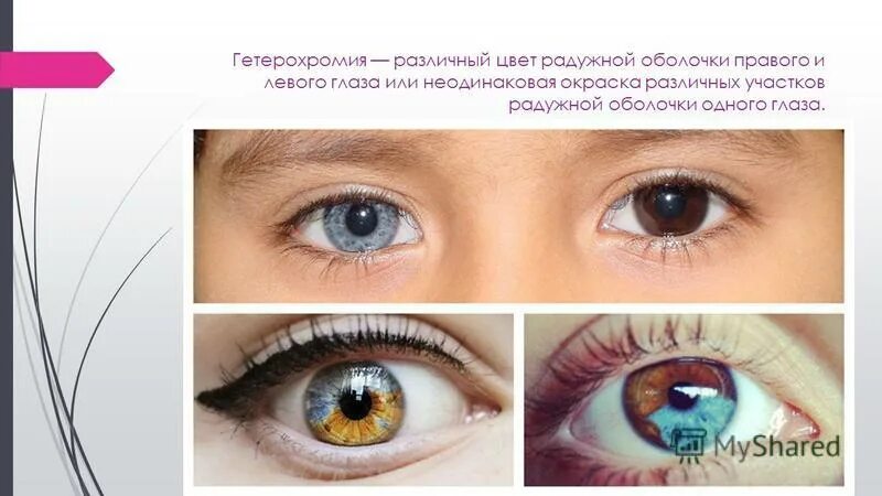 Центральная гетерохромия глаз процент людей. Причины гетерохромии. Стигмы дизэмбриогенеза. Процент гетерохромии. Процент гетерохромии.