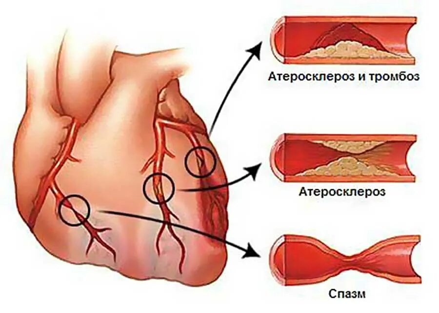 Бляшки коронарных сосудов. Окклюзия коронарных сосудов. Атеросклероз венечных сосудов сердца симптомы. При атеросклеротическом поражении артерий развивается ишемия:. Атеросклеротическое поражение коронарных артерий.