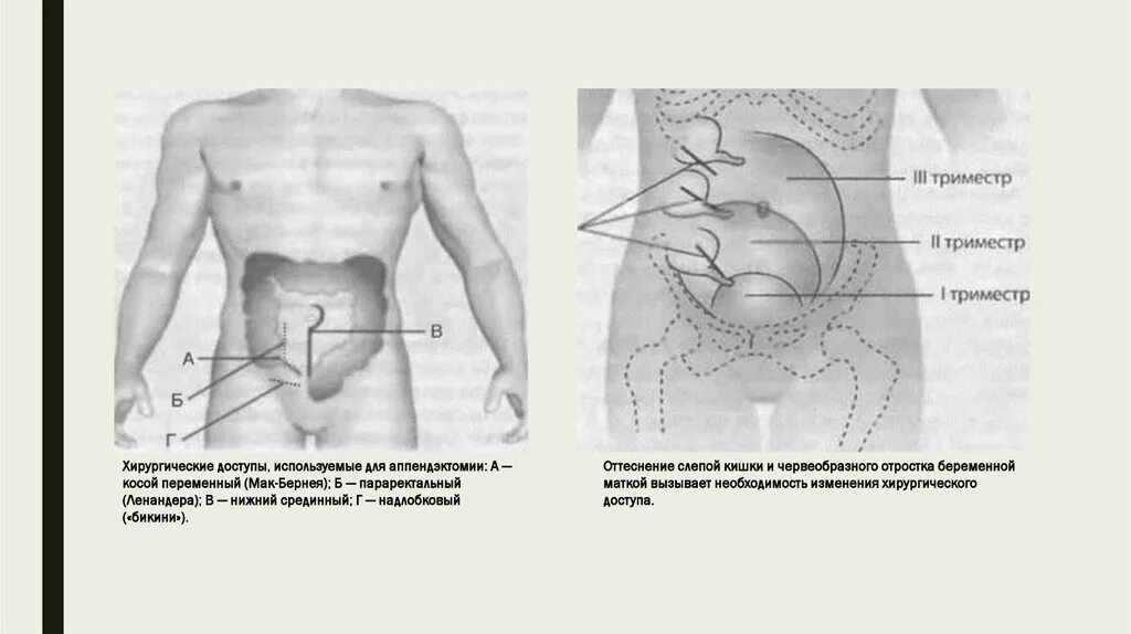 Надлобковая область у мужчин. Погружение культи червеобразного отростка. Хирургические доступы при аппендэктомии. Область проекции слепой кишки на брюшную стенку.