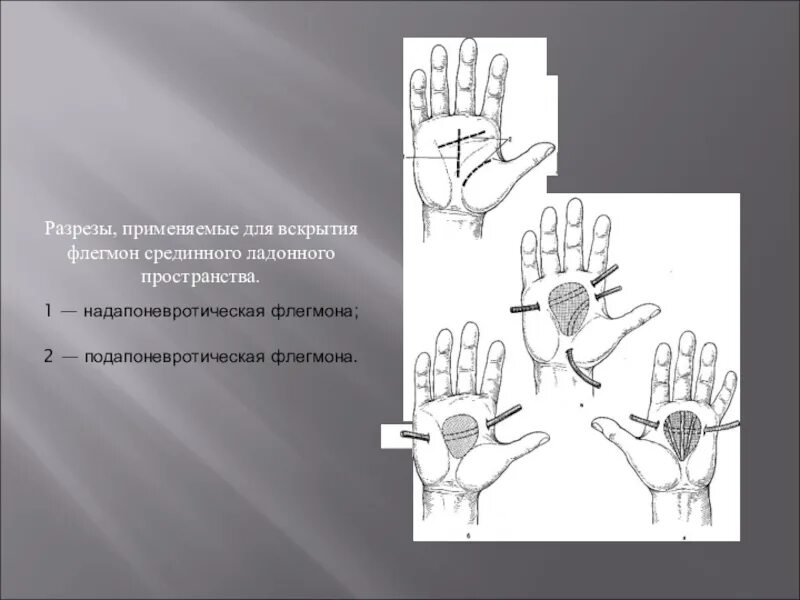Линии разрезов при вскрытии флегмон предплечья. Флегмона срединного пространства кисти. разрез при флегмоне срединного ладонного пространства кисти. надапоневротическая флегмона кисти. вскрытие подапоневротической флегмоны тыла кисти.