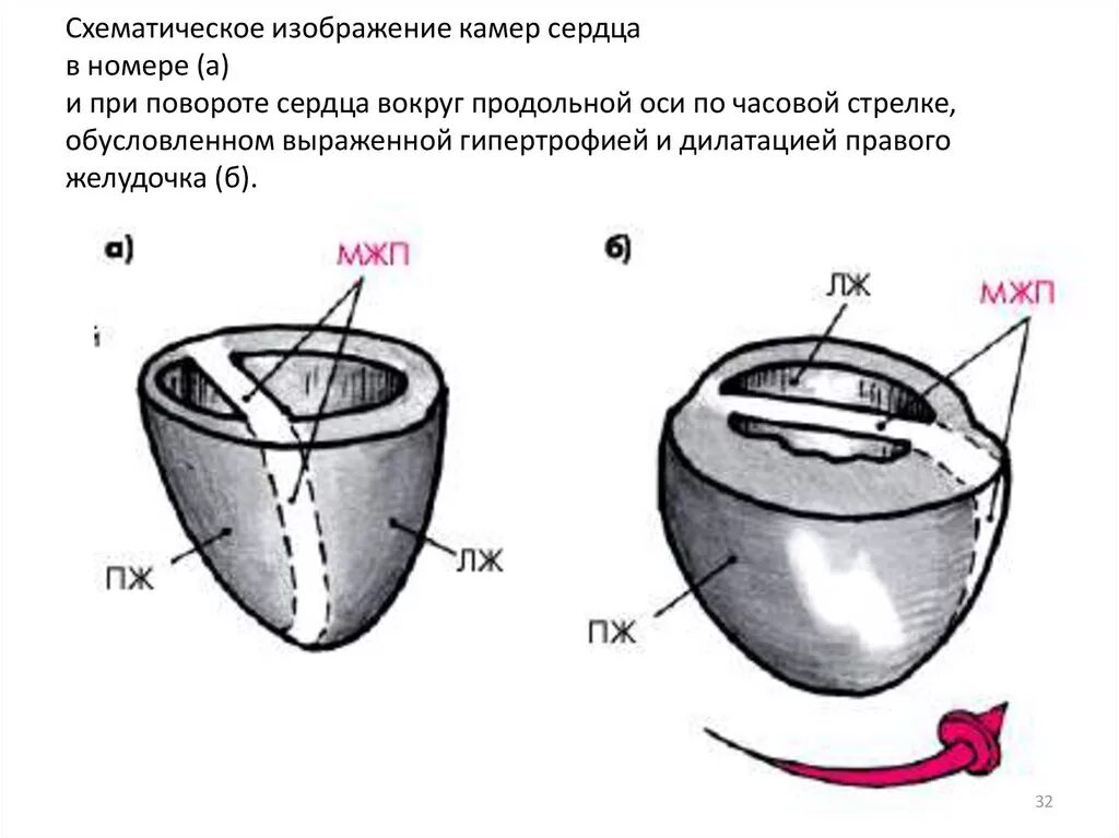 Поворот оси против часовой стрелки. Поворот сердца вокруг продольной оси. поворот сердца вокруг продольной оси по часовой стрелке. поворот сердца по продольной оси против часовой стрелки. повороты сердца на экг вокруг продольной оси.