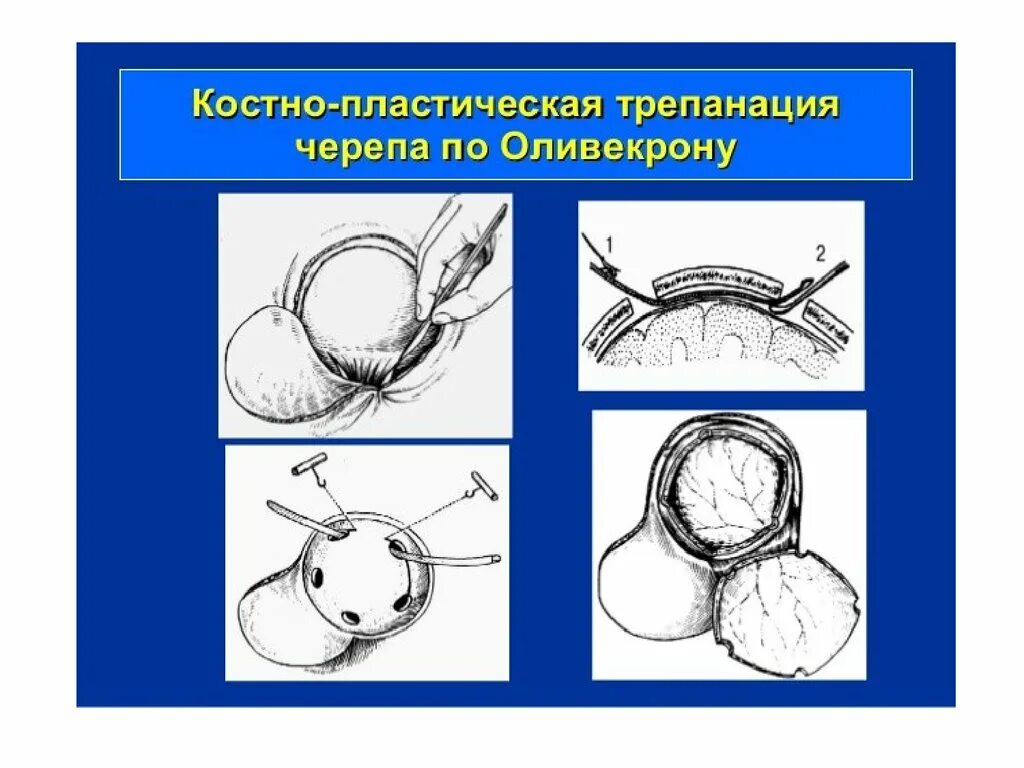 Костно-пластическая Трепанация черепа по Оливекрону. Костно пластическая Трепанация Вагнер Вольф. Костно-пластическая Трепанация черепа этапы. Двухлоскутная костнопластическая Трепанация черепа по по Оливекрону.