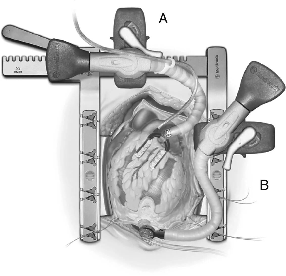 Операция шунтирование сосудов сердца. 5 catheter with maquet pump. Off pump. Памп слушать. Backwashing (water treatment).
