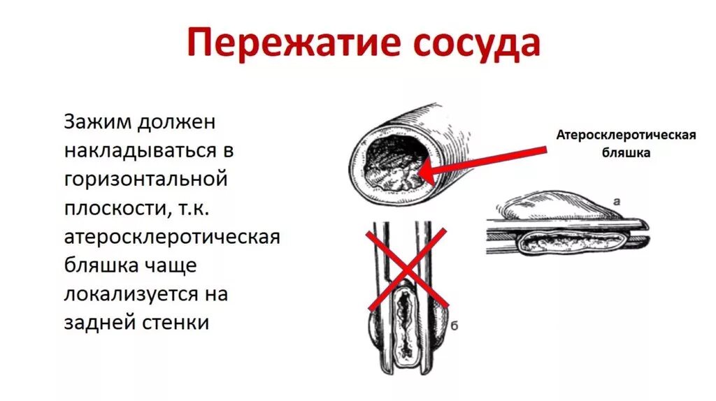 Тампонада раны при кровотечении. Наложение кровоостанавливающего зажима. Наложение зажима Бильрота. Наложение кровоостанавливающего зажима на кровоточащий сосуд. Сосудистые зажимы.