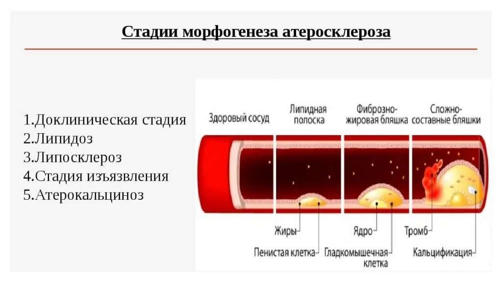 Стадии развития атеросклероза макроскопические. Стадии развития атеросклероза патанатомия. Атеросклероз степень и стадия развития. Атеросклероз периоды развития.