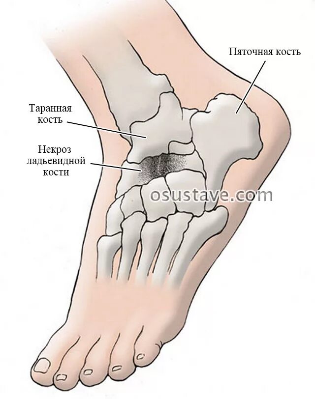 Болезнь Келлера 1 остеохондропатия ладьевидной кости. Ладьевидная кость стопы болезнь Келлера. Болезнь Келлера 2 кости. Келлера 2 плюсневой кости стопы. Болезнь келлера что это такое