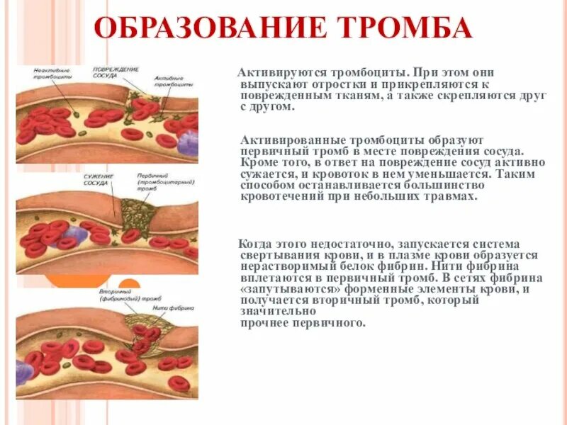 Количество фибрина после пореза. Схема образования тромбоцитарного тромба. Тромбоциты крови тромб образование. Процесс образования тромба в крови. Образование тромбов в артериях.