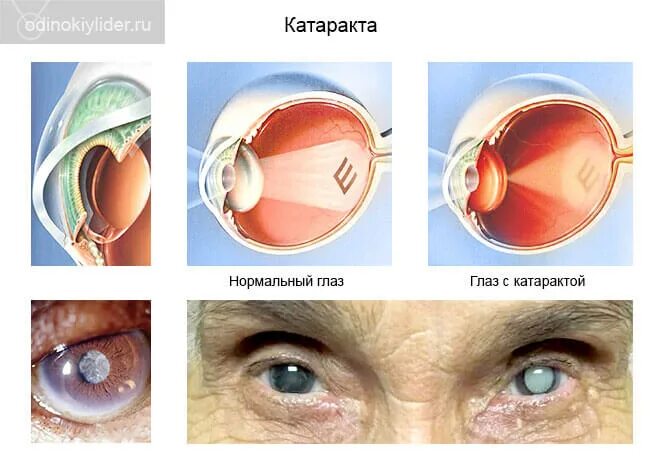 Что можно делать после катаракты. Хрусталик глаза. Искусственный хрусталик. Искусственный хрусталик глаза.