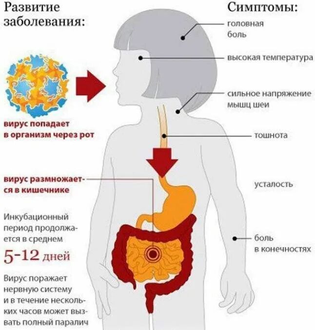Полиомиелит симптомы пути передачи. Полиэмилит что за болезнь. Полиомиелит инфекционное заболевание. Спинальная форма полиомиелита. Полиэмилит что за болезнь.
