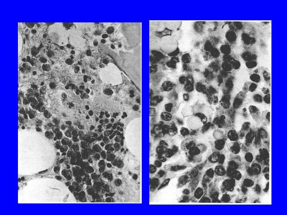 Миеломная болезнь что. Трепанобиопсия миелома. Патанатомия миеломной болезни. Миеломная болезнь патологическая анатомия. Миеломная болезнь лейкоз.