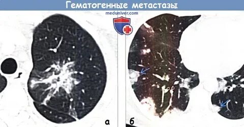 Метастазы на кт