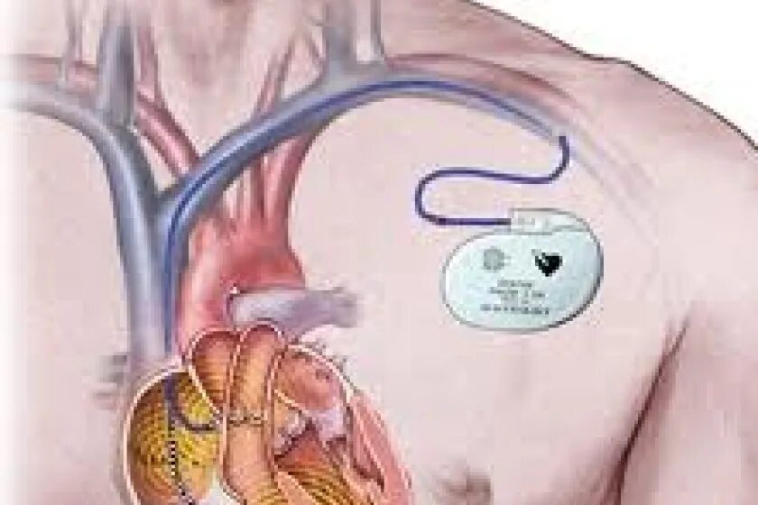 Если стоит кардиостимулятор можно. Первый кардиостимулятор. Однокамерный кардиостимулятор сердца. Внутренний кардиостимулятор. Кардиостимулятор Размеры.