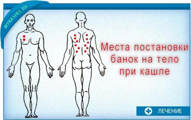 Постановка банок на спину детям. Схема постановки банок при пневмонии. Как правильно поставить банки на спину. Схема постановки банок на спину при кашле. Как правильно поставить медицинские банки при кашле.