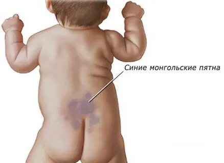 Монгольское пятно у ни капли не монгольского ребенка))) - страна мам 