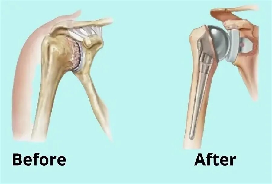 Операция по замене плечевого сустава. Замена плечевого сустава по квоте. Замена плечевого сустава по ОМС. Замена плечевого сустава цена.