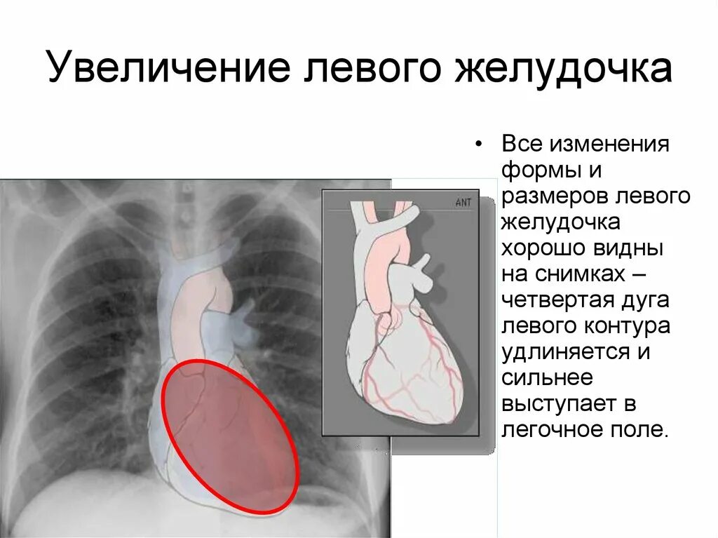 Увеличение левого желудочка. Расширение желудка в сердце. Увеличен левый желудочек. Увеличение левого желудочка на рентгене. Желудочка сердца расширена