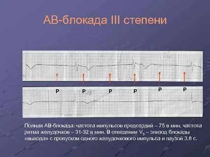 Ав 3 степени