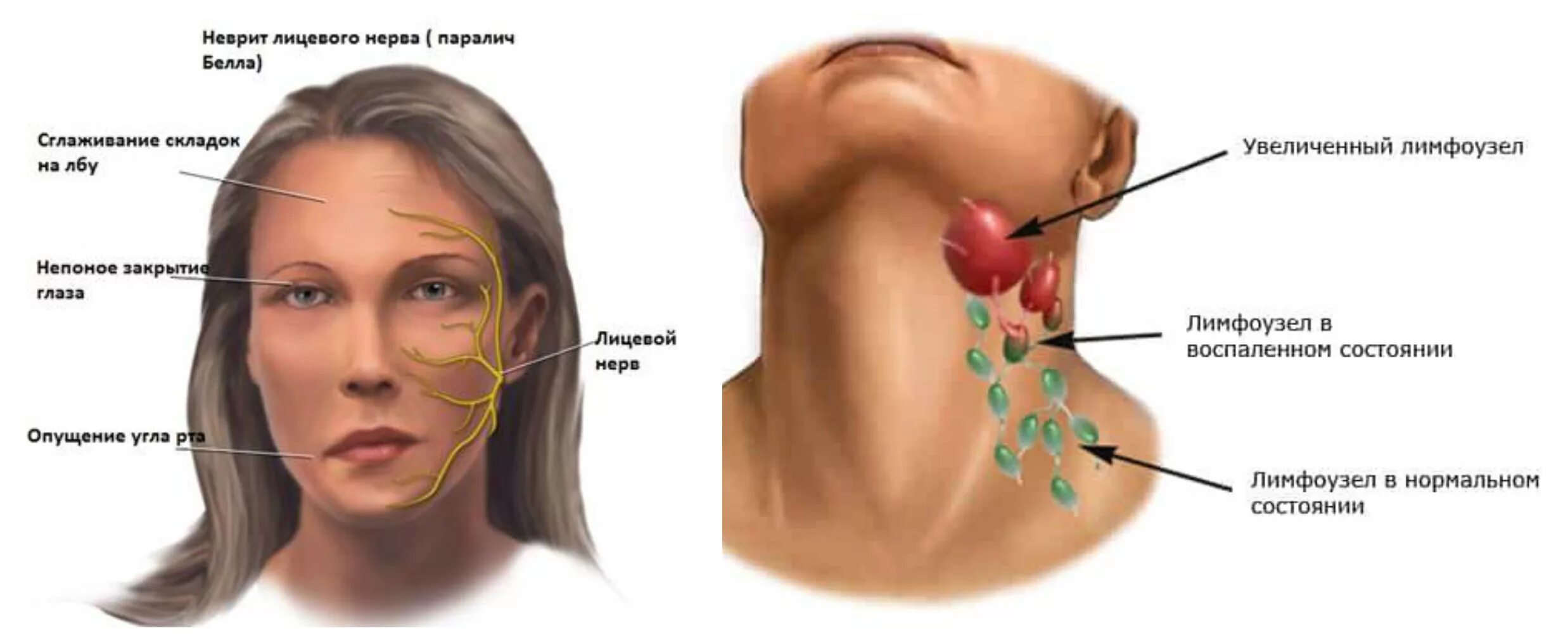 неодонтогенный лимфаденит. тонзиллярный лимфаденит. лимфоузлы шейного отдела сзади. околоушные лимфатические узлы схема. нижнечелюстные лимфоузлы расположение.