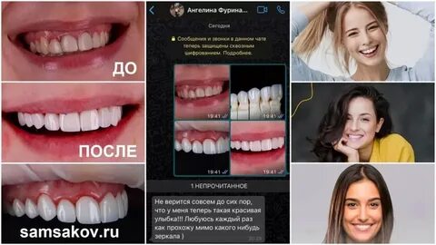 Сколько стоят виниры на все зубы