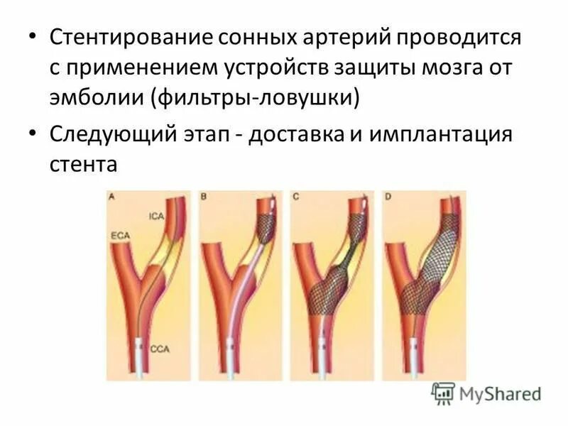 Процент стеноза сосудов. Стентирование сонной артерии. Каротидная эндартерэктомия сонной артерии стент. Антитромботическая терапия после стентирования сонных артерий. Стентирование брахиоцефальных артерий.