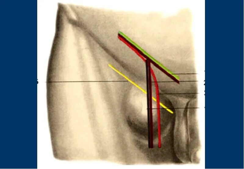 Тянет в паху справа у мужчин. Паховая и бедренная грыжа. Бедренная паховая грыжа операция. Бедренная грыжа анатомия. Бедренный треугольник бедренные грыжи.