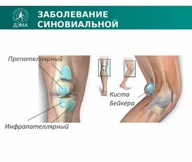 Лечение кисты под микроскопом
