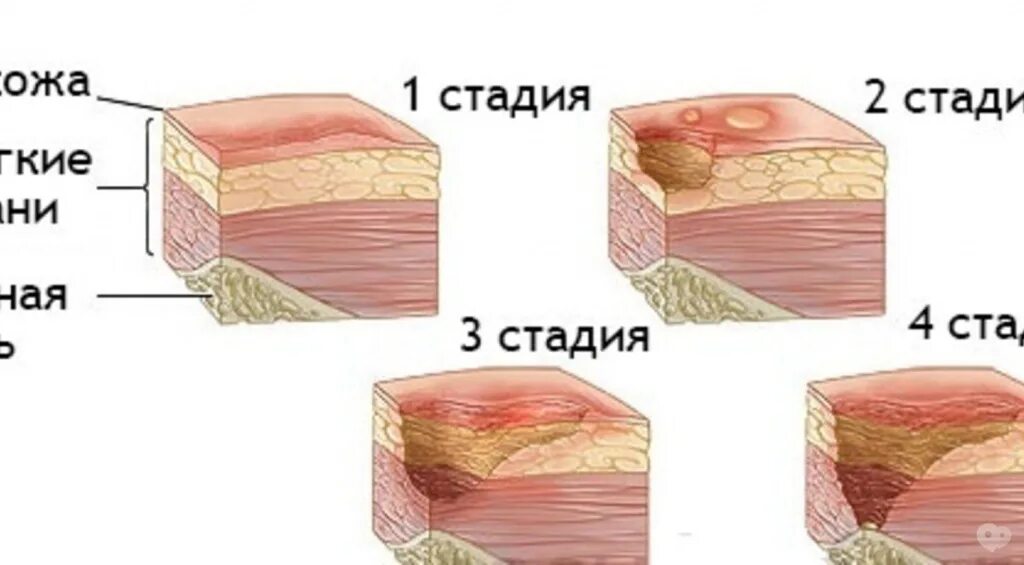 Уход за язвами. Четвертая стадия развития пролежней. Трофические язвы кожных покровов. Гангрена пролежни секвестр.