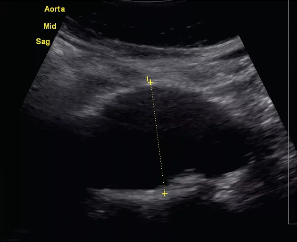 Сильно пульсирует живот. УЗИ аорты. Брюшная аорта пульсирует. Брюшная аорта на УЗИ брюшной полости.