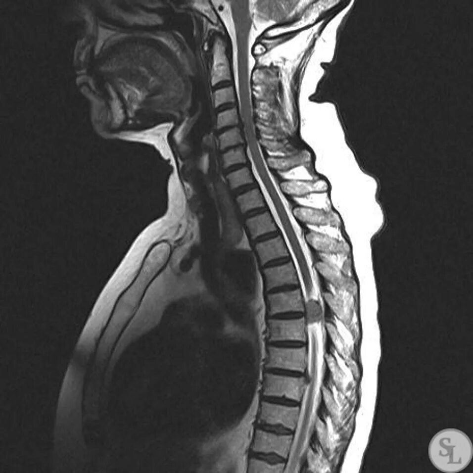 Менингиома спинного мозга грудного отдела. Менингиома позвоночника кт. Менингиома шейного отдела позвоночника. Менингиома спинного мозга грудного отдела мрт. Опухоль в поясничном отделе