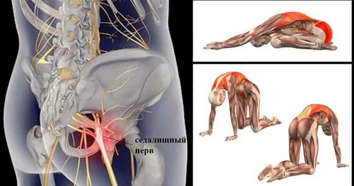 Как лечить защемление в пояснице. Ишиас воспаление седалищного. Ишиас воспаление седалищного нерва. Защемление седалищного нерва s1. Седалищный нерв (sciatic nerve)? 011.